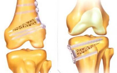 استئوتومی زانو؛ بهترین روش درمان انحراف زانو